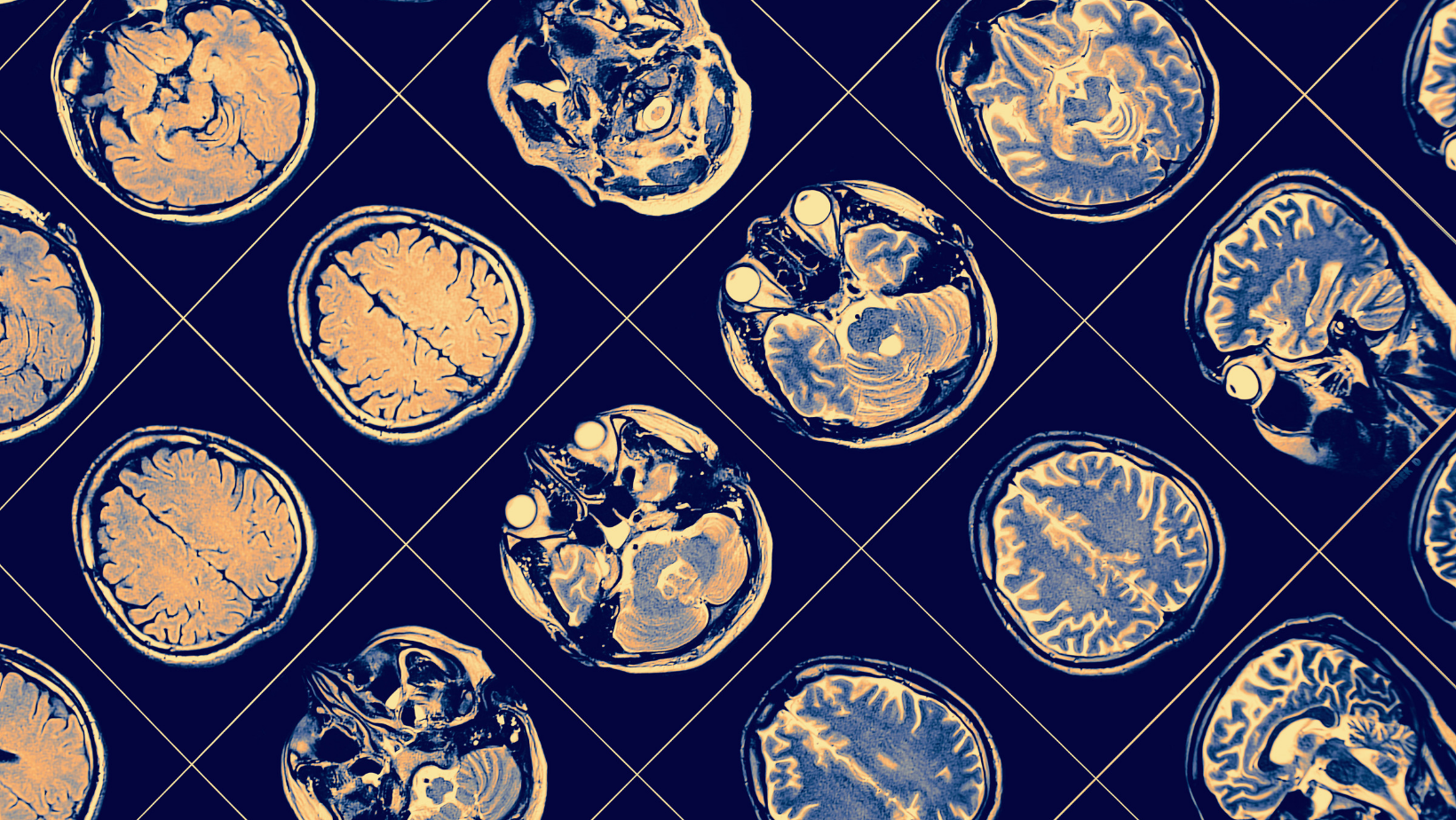 Deciphering the Complex Relationship Between Alcohol and the Brain
