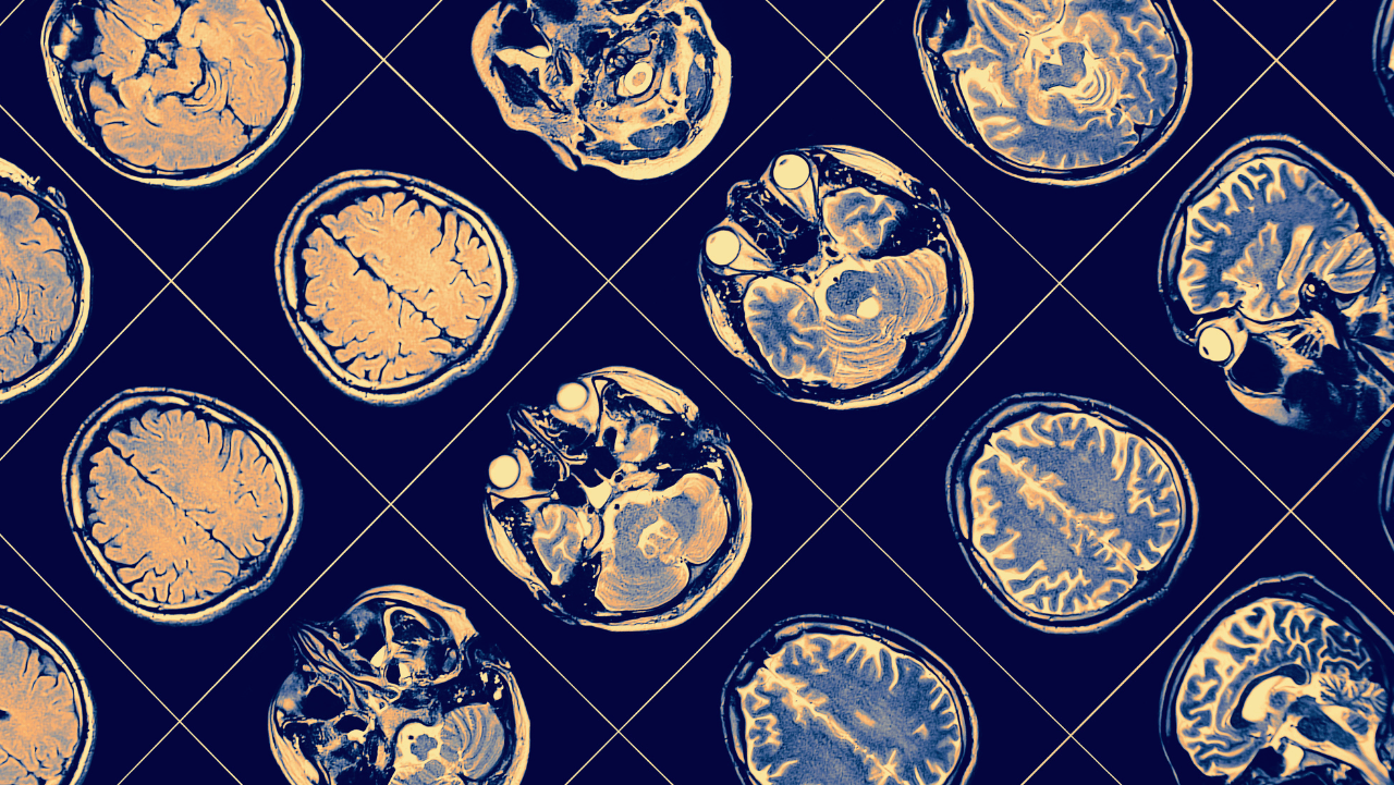 How Can Family Members Recognize Schizophrenia Symptoms Early? Key Signs and Steps for Early Detection