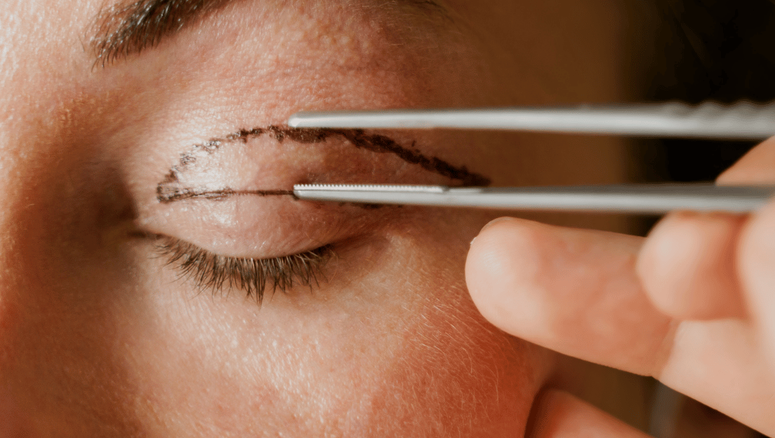 My Top 6 Tips to Recover Quickly From Blepharoplasty