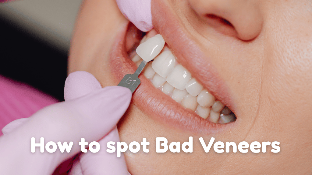 How to spot bad veneers – 8 signs you should look out for
