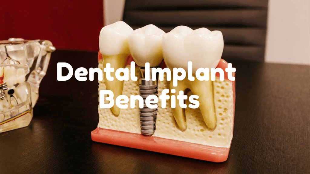 Unexpected Benefits You’ll Get From Dental Implants