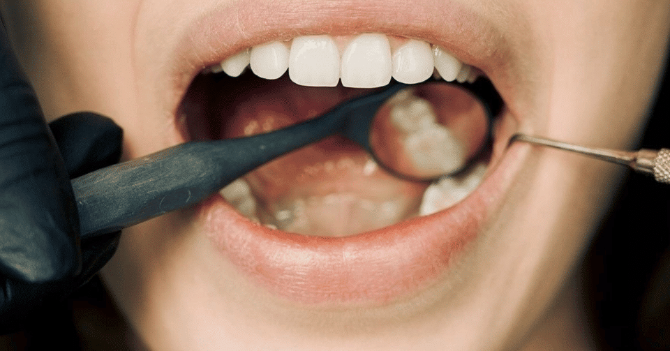 How Long Does Dental Bonding Actually Last?