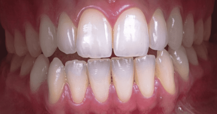What Causes Bleeding Gums and How to Stop It Effectively