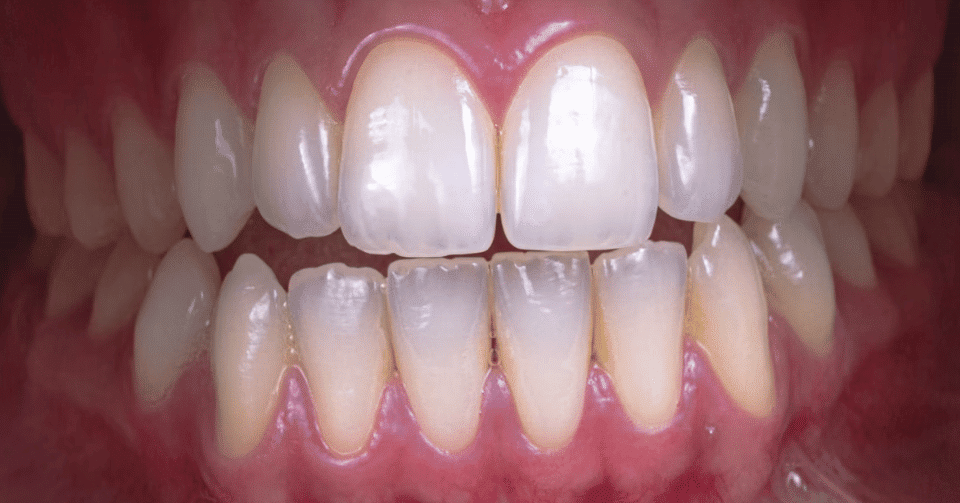 What Causes Bleeding Gums and How to Stop It Effectively