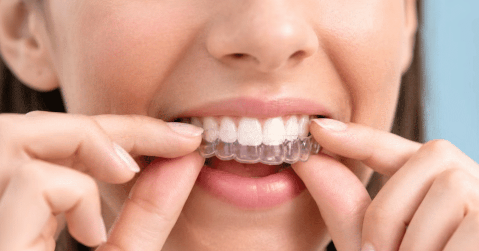 Simple Habits to Keep Your Clear Aligners Clean