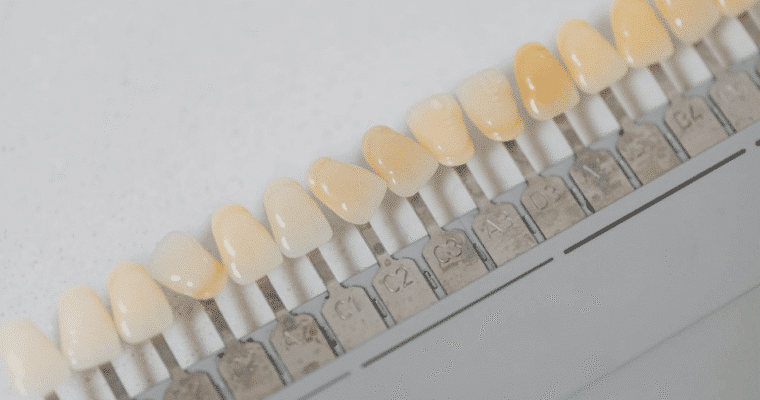 Veneers vs Bonding