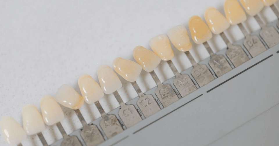 Veneers vs Bonding for Chipped Teeth Repair