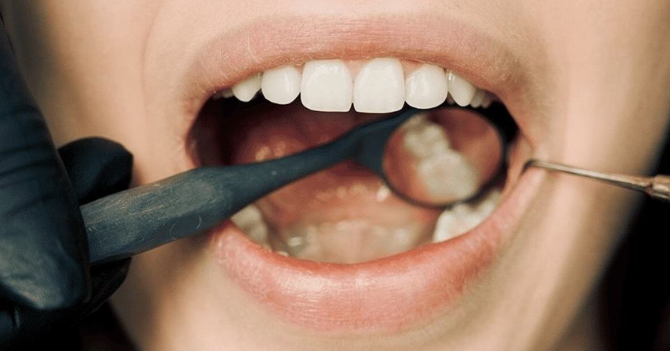 What to Eat After a Tooth Filling
